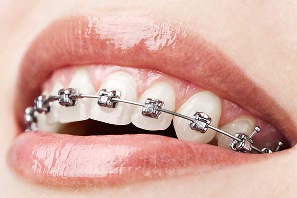 aparelho dental autoligado